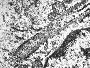 M,41y. | hairy cell leukemia - spleen - ribosome-lamella complex in tricholeukocyte